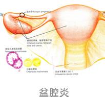 盆腔炎的预防措施都有哪些？