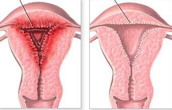 子宫内膜炎早期症状