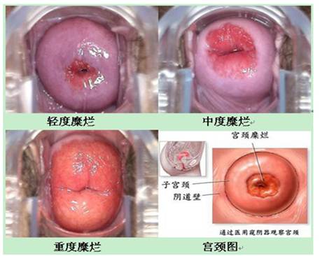 宫颈糜烂常见症状